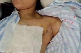甲狀腺微創(chuàng)手術(shù)可讓患者脖子不留疤痕