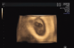 首位在梧州地區(qū)通過“試管嬰兒”技術(shù)助孕婦女成功懷孕！