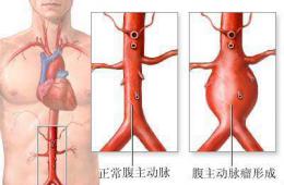 人體“不定時炸彈”突爆！妙手神醫(yī)凌晨救回七旬危重患者