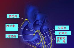 我院成功施行市內(nèi)首例希氏束起搏治療房室傳導阻滯患者