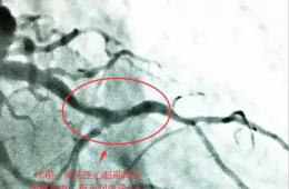 【別開生面的血管疏通戰(zhàn)】我院首次以逆向?qū)Ыz法救治患者